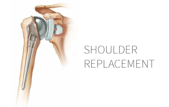 shoulder bones and shoulder replacement surgery