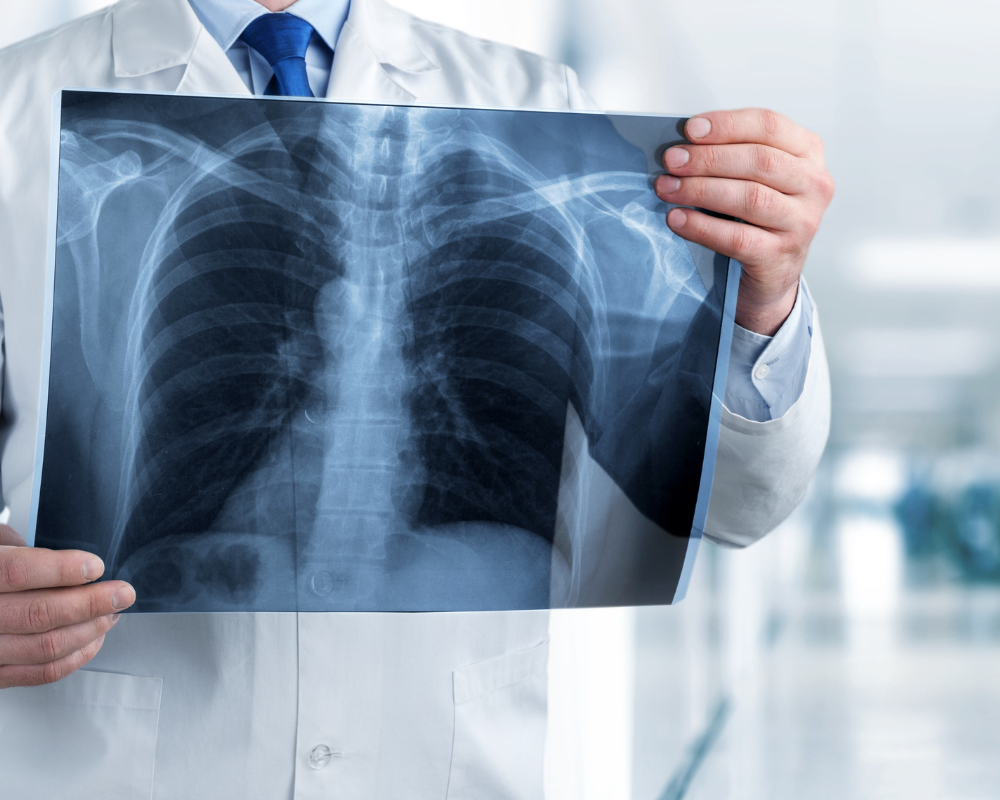 A doctor in a white lab coat holds up a chest X-ray, displaying the ribs, spine, and lungs. The background is blurred, suggesting a clinical or hospital setting. The doctor’s face is not visible, focusing attention on the X-ray image.